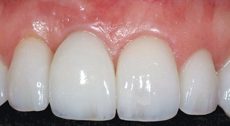 Лечение передних зубов