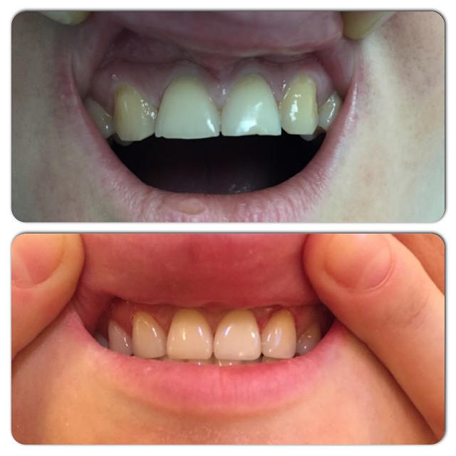 Реставрация 4 передних зубов до и после