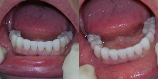 Зубы после утановки виниров